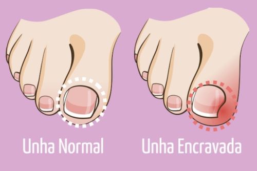 Unha encravada precisa ser tratada por especialista